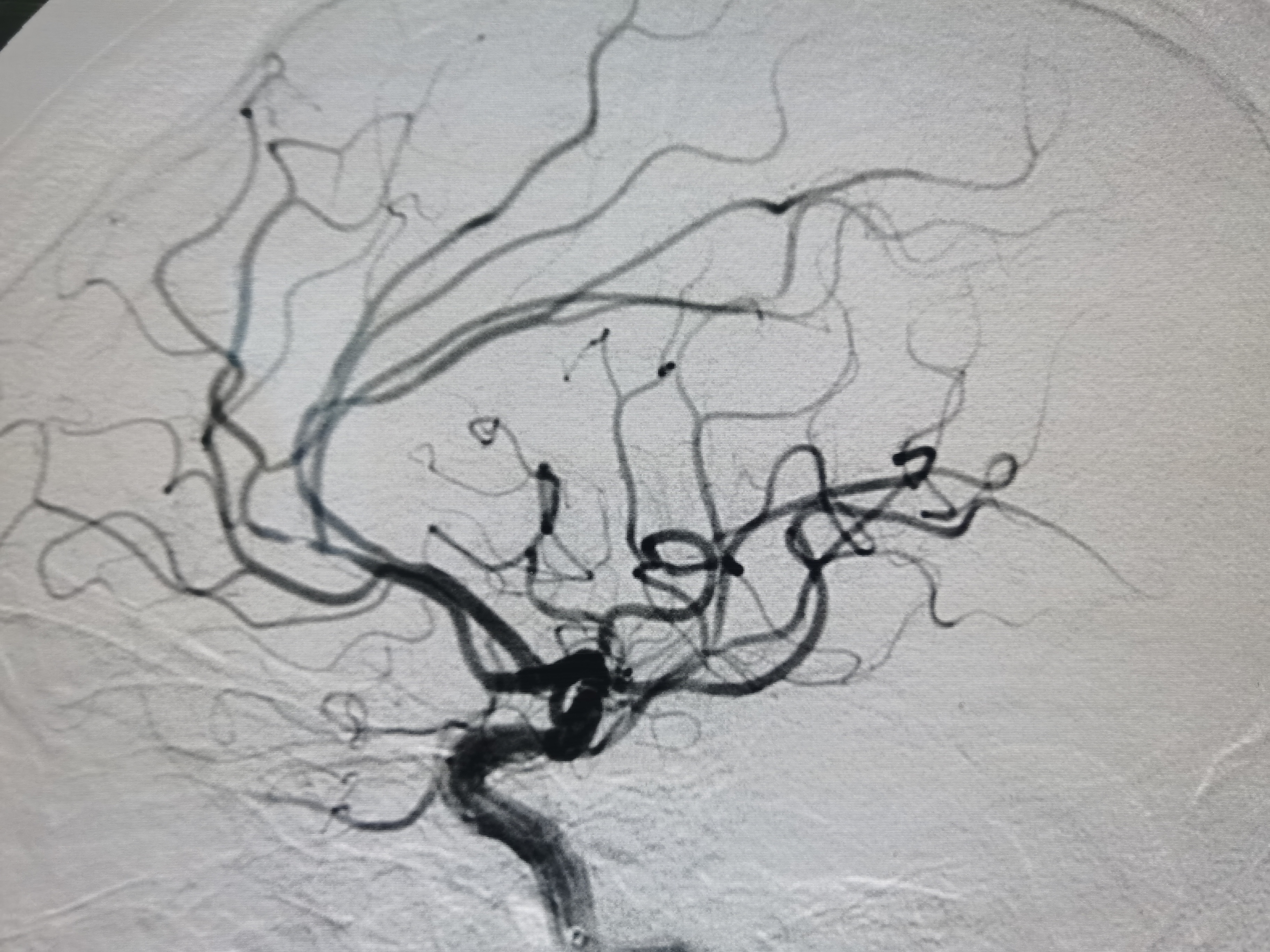 不同凡响|(第64期)心源性栓塞血管内治疗一例 - 脑医汇 - 神外资讯