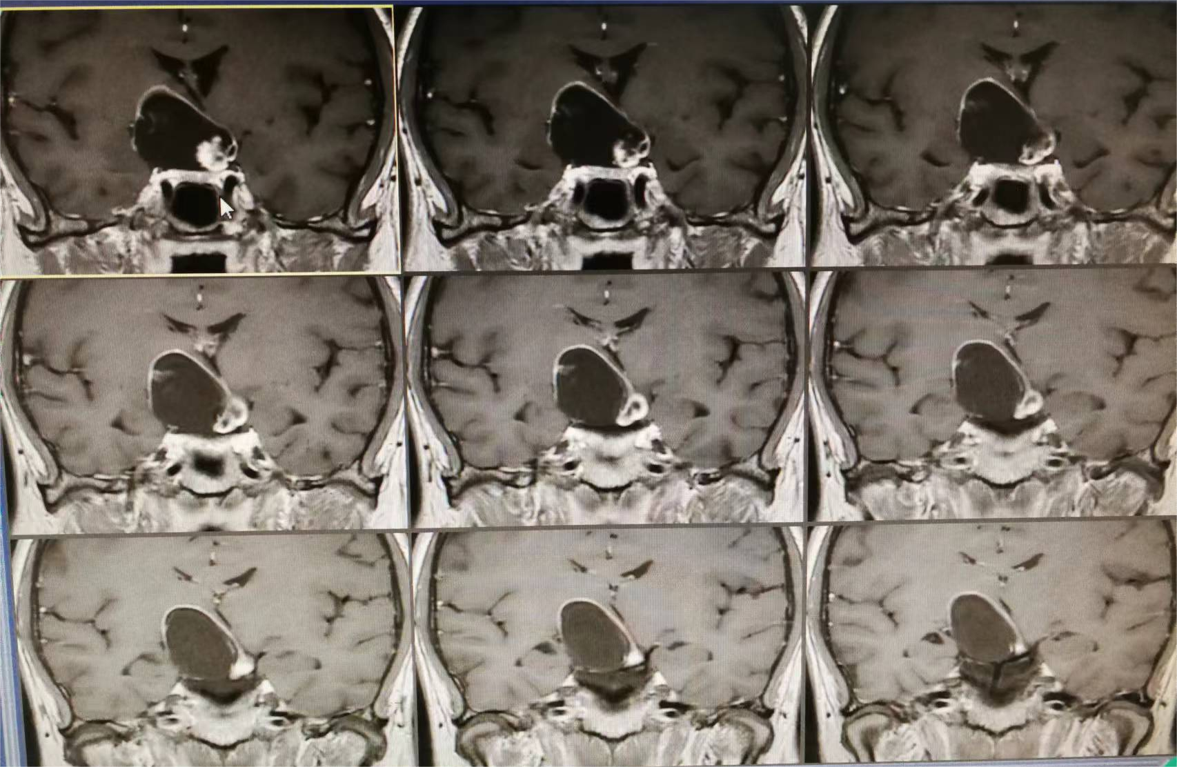 北医三院门诊预约CT加急-北医三院门诊预约ct加急要多久 