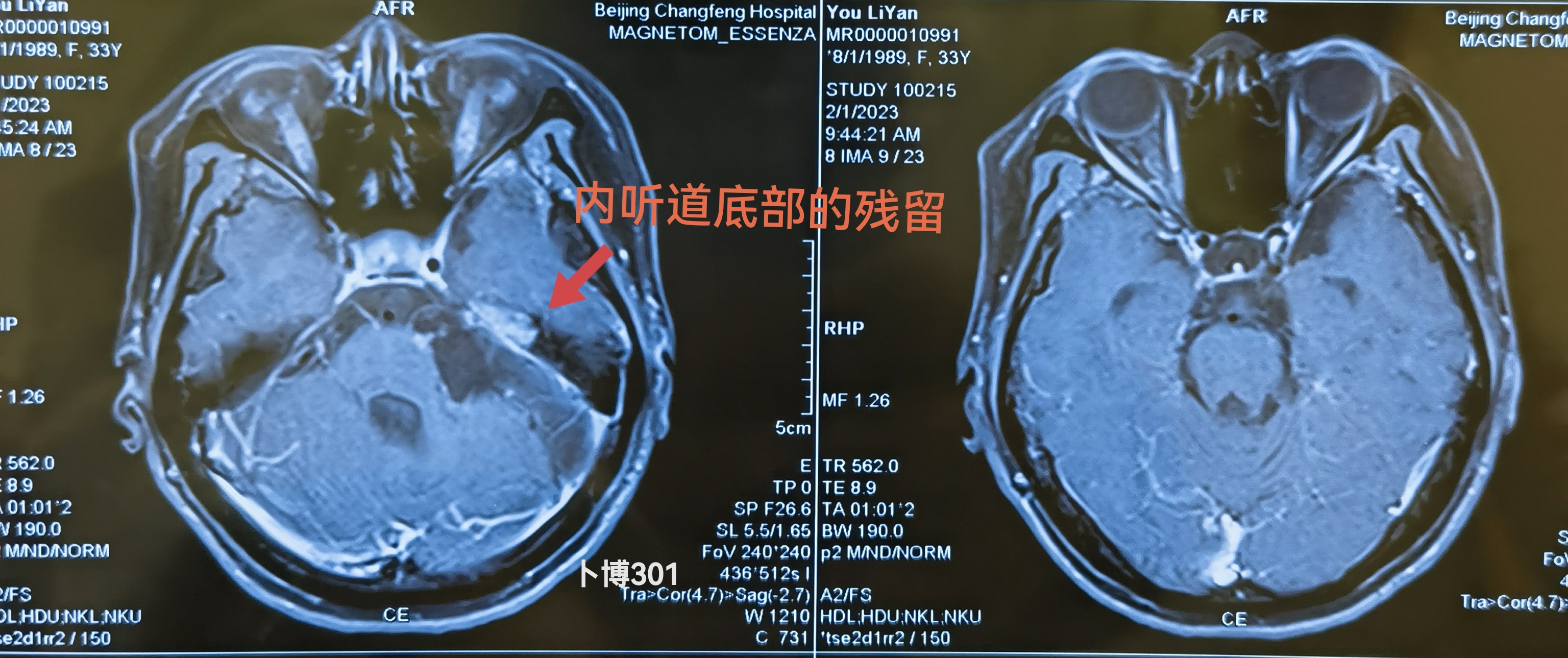 左侧巨大听神经瘤 - 脑医汇 - 神外资讯 - 神介资讯