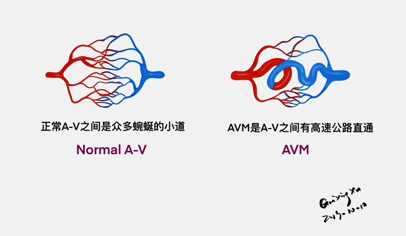 AVM - 脑医汇