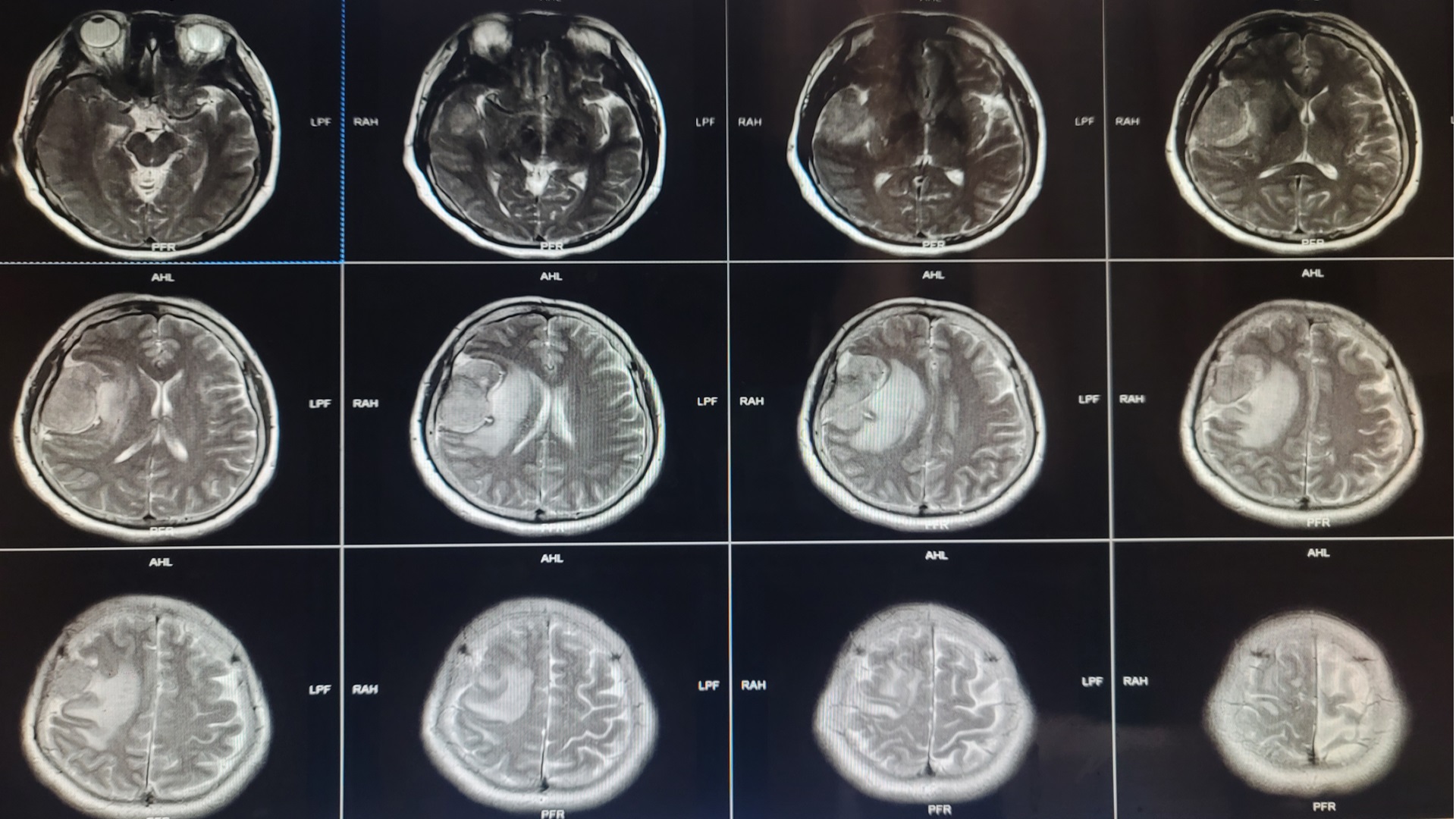 一例额颞部脑膜瘤，与周围脑组织、血管粘连紧密，蛛网膜界面消失，分离难于分侧裂。 - 脑医汇