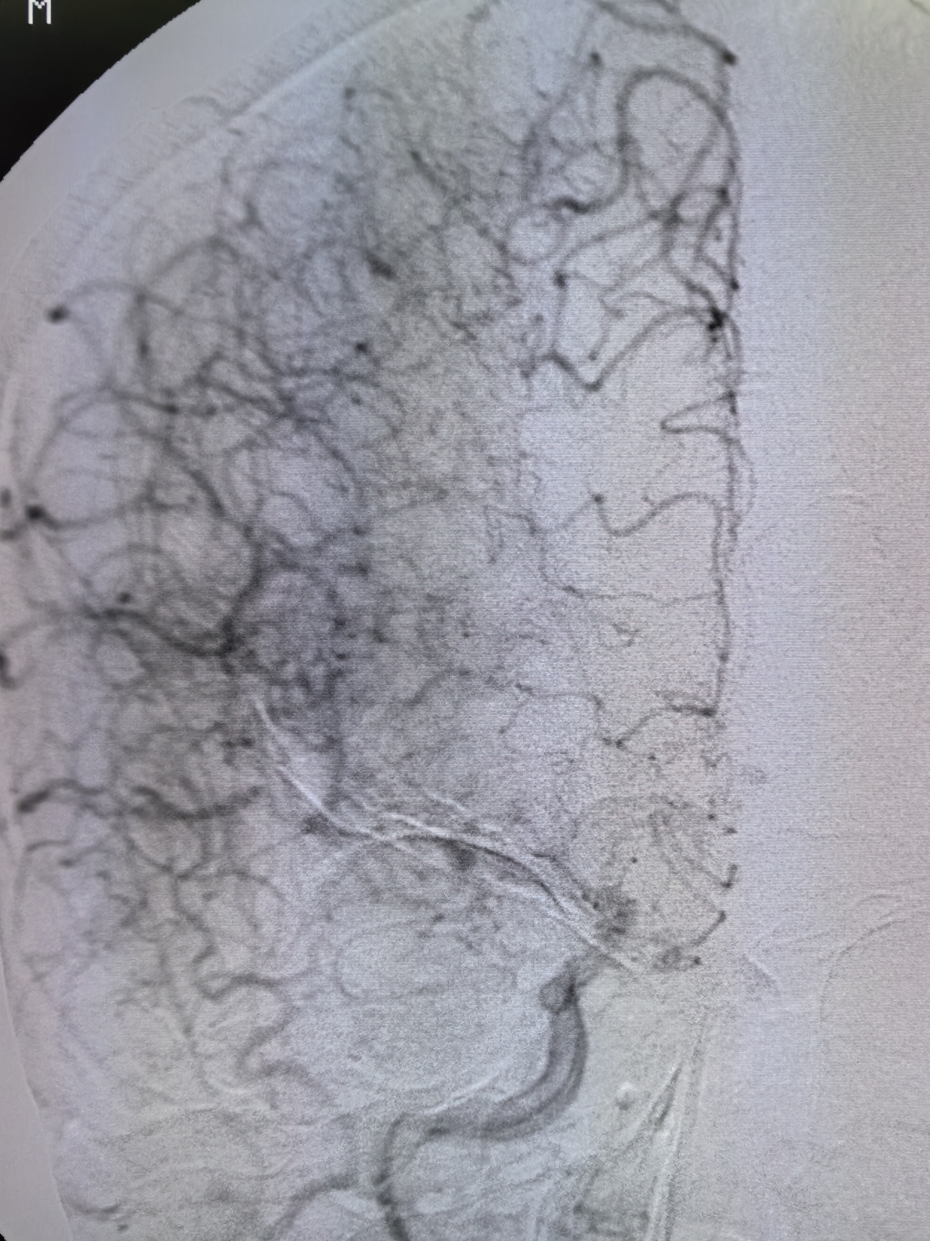 不同凡响|(第152期)老年男性心源性栓塞血管内治疗一例 - 脑医汇 - 神