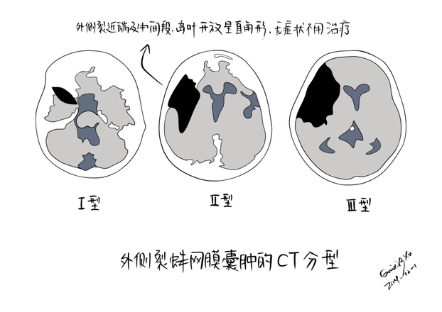 外侧裂处蛛网膜囊肿分型与治疗 - 脑医汇 - 神外资讯 - 神介资讯