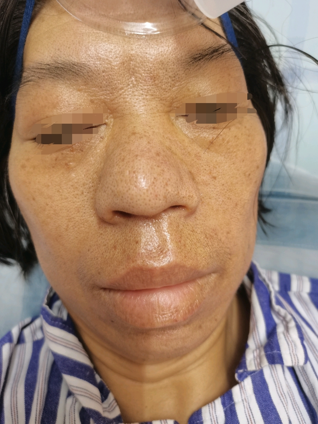 垂体大腺瘤合并肢端肥大症内镜手术一例