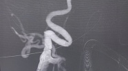 RPcom动脉瘤（刘Zhj～04.03）