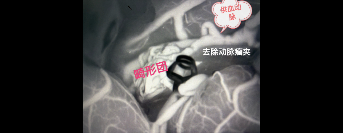 右侧侧裂脑AVM切除术