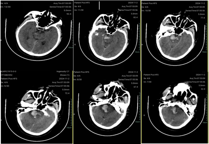 全内镜下锁孔乙状窦后入路脑干血管畸形切除加血肿清除术（附手术视频）