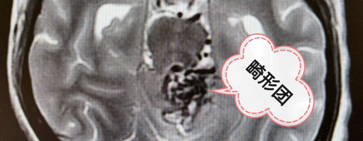 脑干AVM切除术（中脑后方型）