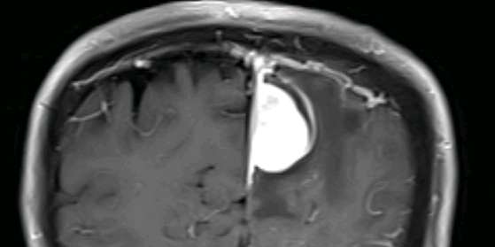 左顶枕大脑镰旁脑膜瘤切除