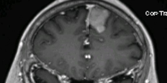 左额镰窦旁脑膜瘤切除