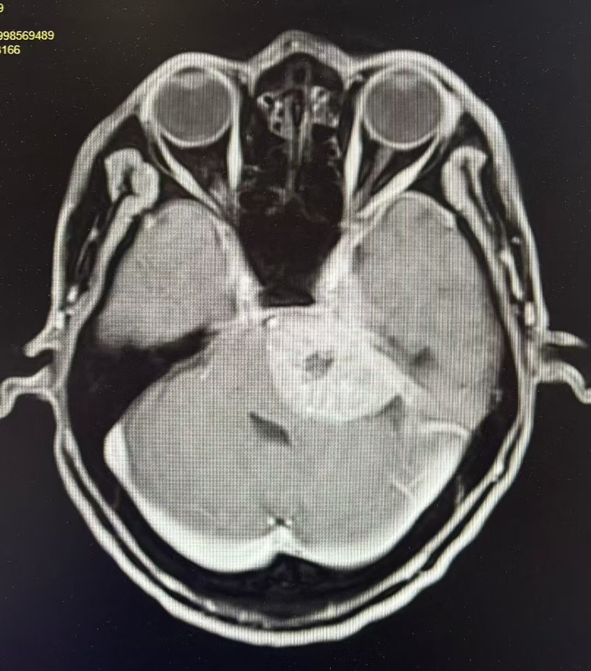 kawase 入路：岩斜区脑膜瘤切除术