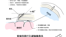 硬脑膜骨窗四周打孔悬吊