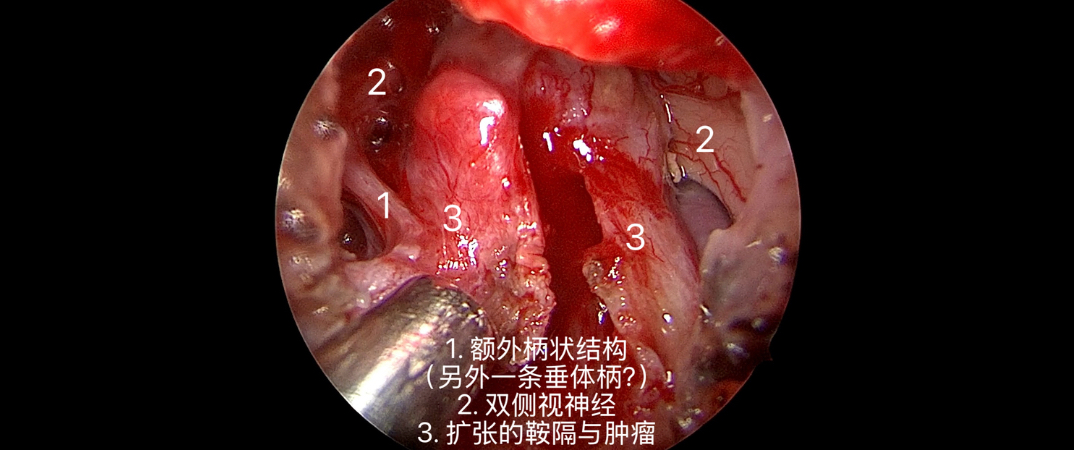 1例罕见垂体柄重复畸形儿童颅咽管瘤