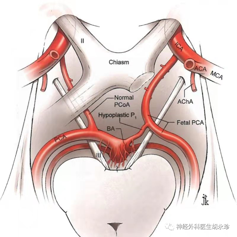 動眼神經向前走向後床突兩側,準備進入海綿竇