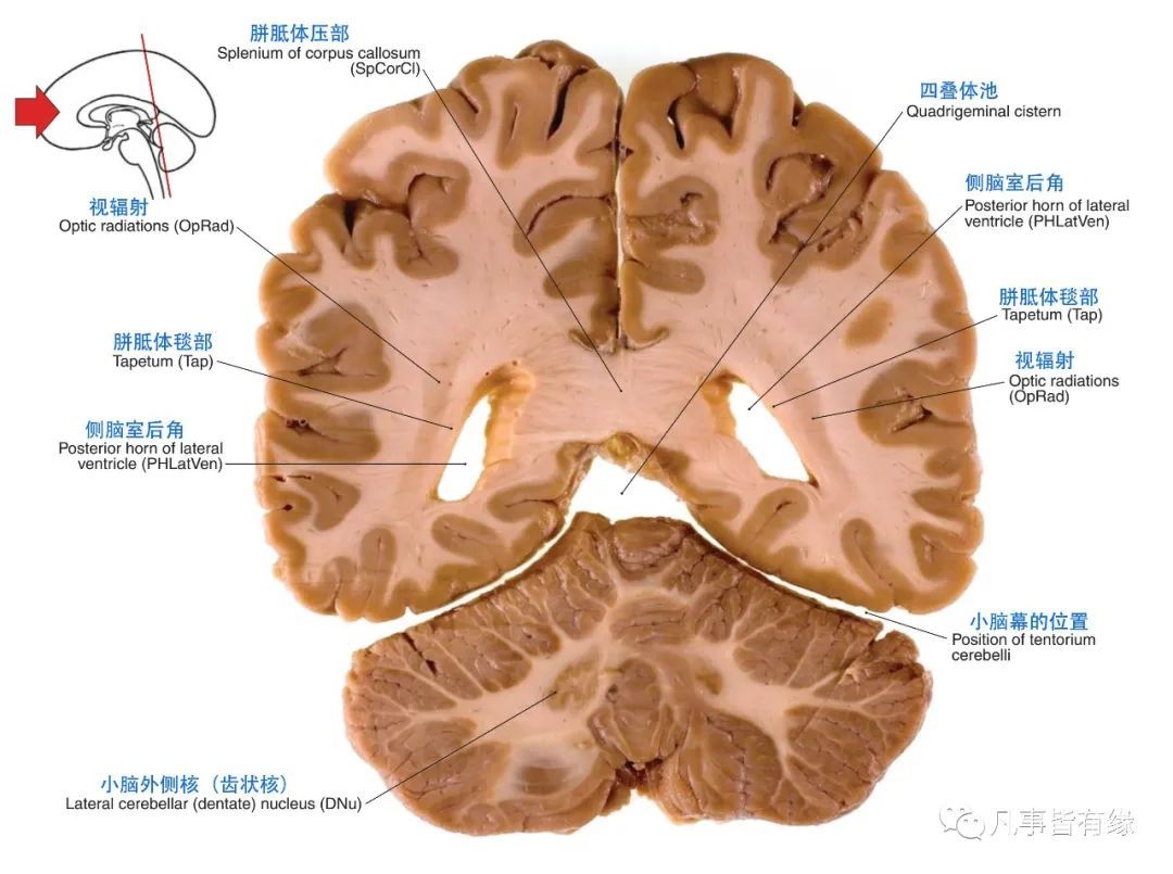 冠状断层线条图section anatomy四,颅脑mri冠状断层解剖结构标注