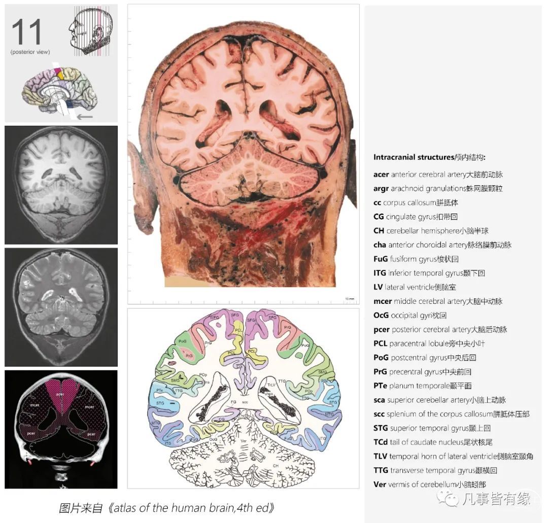四,颅脑mri冠状断层解剖结构标注section anatomy特别申明:以上美图