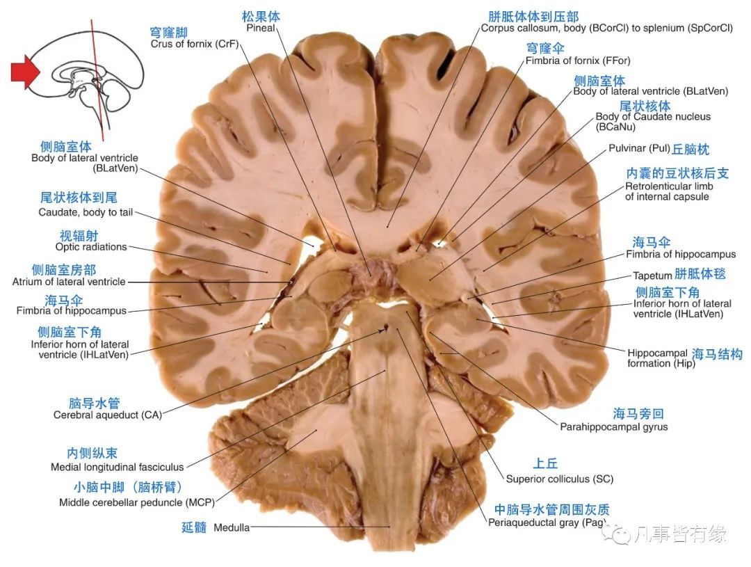 冠状断层线条图section anatomy四,颅脑mri冠状断层解剖结构标注