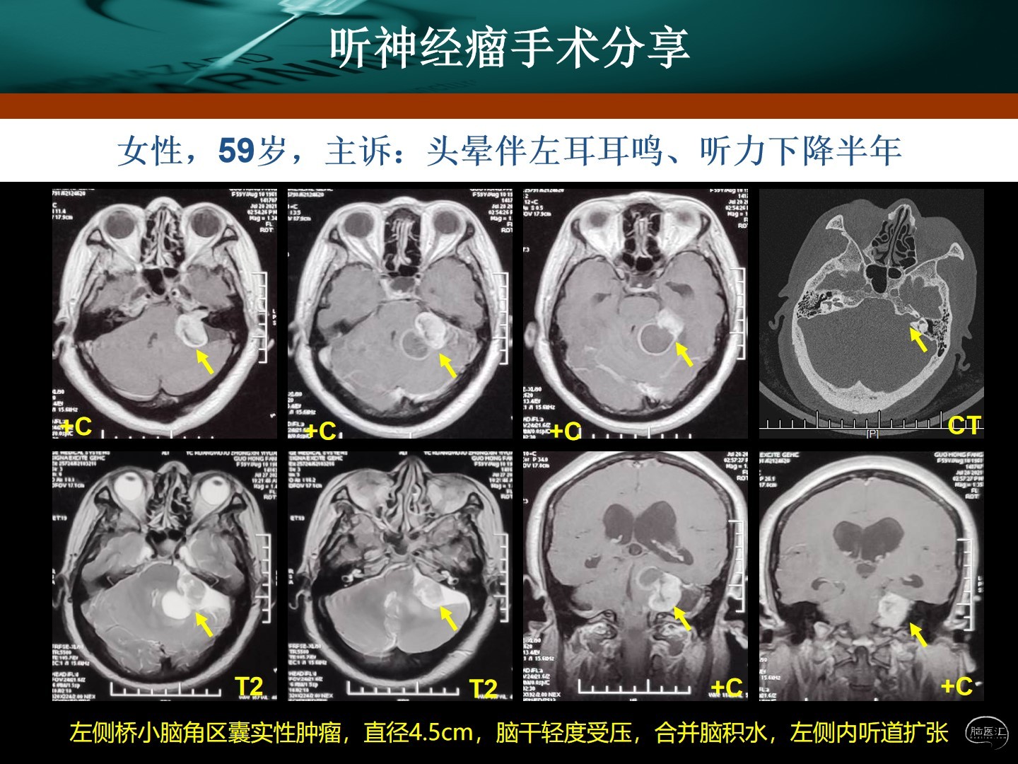 王拓教授團隊聽神經瘤手術分享附手術視頻