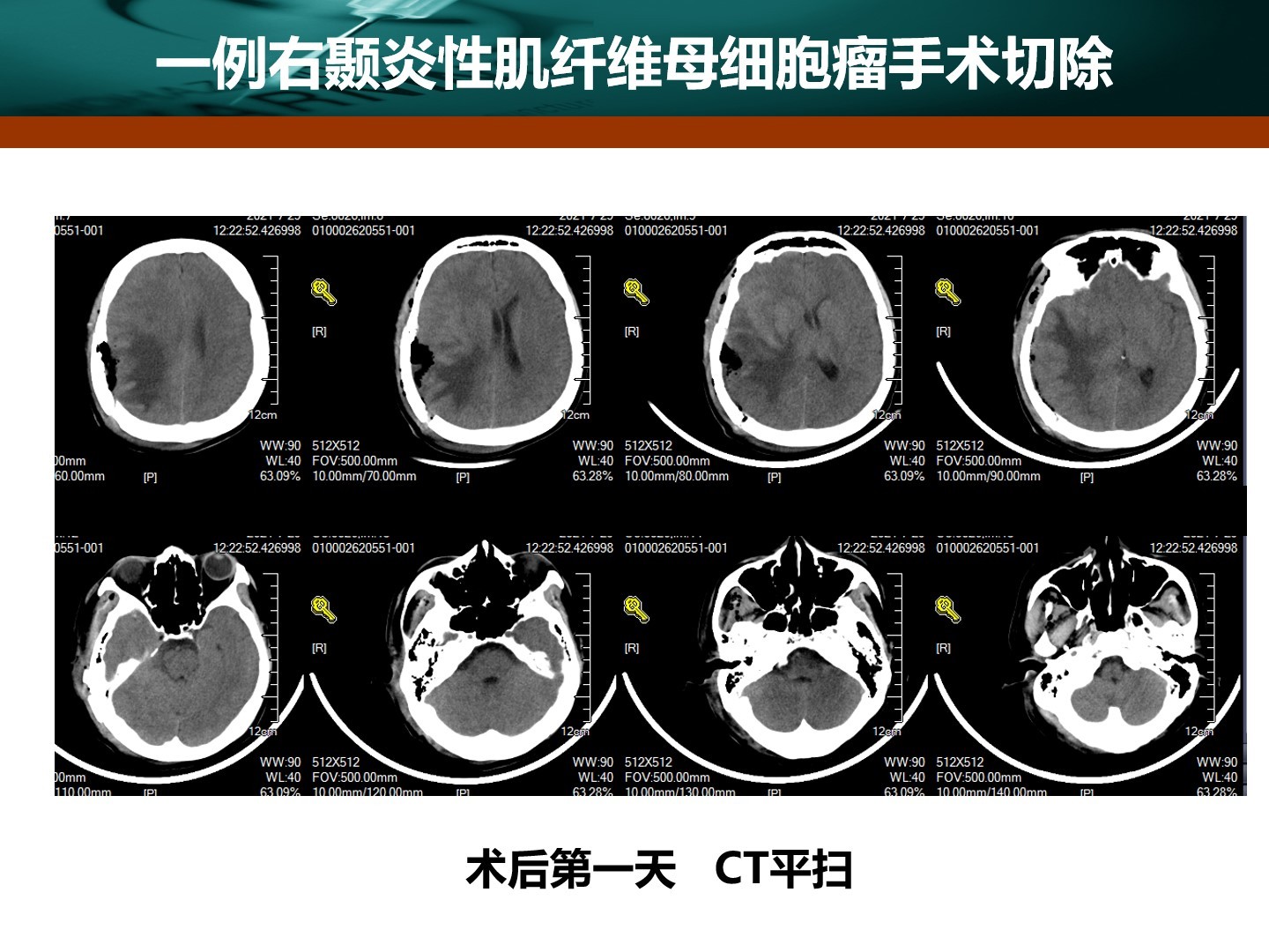 王拓教授團隊一例右顳炎性肌纖維母細胞瘤手術切除