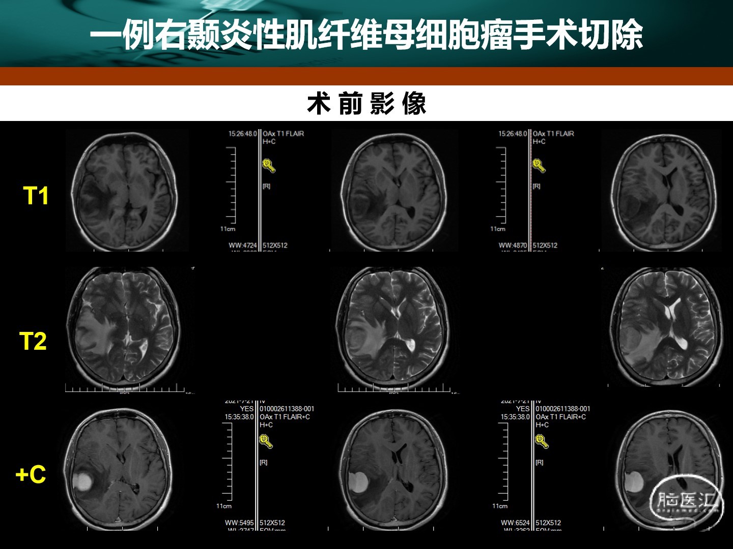 王拓教授團隊一例右顳炎性肌纖維母細胞瘤手術切除