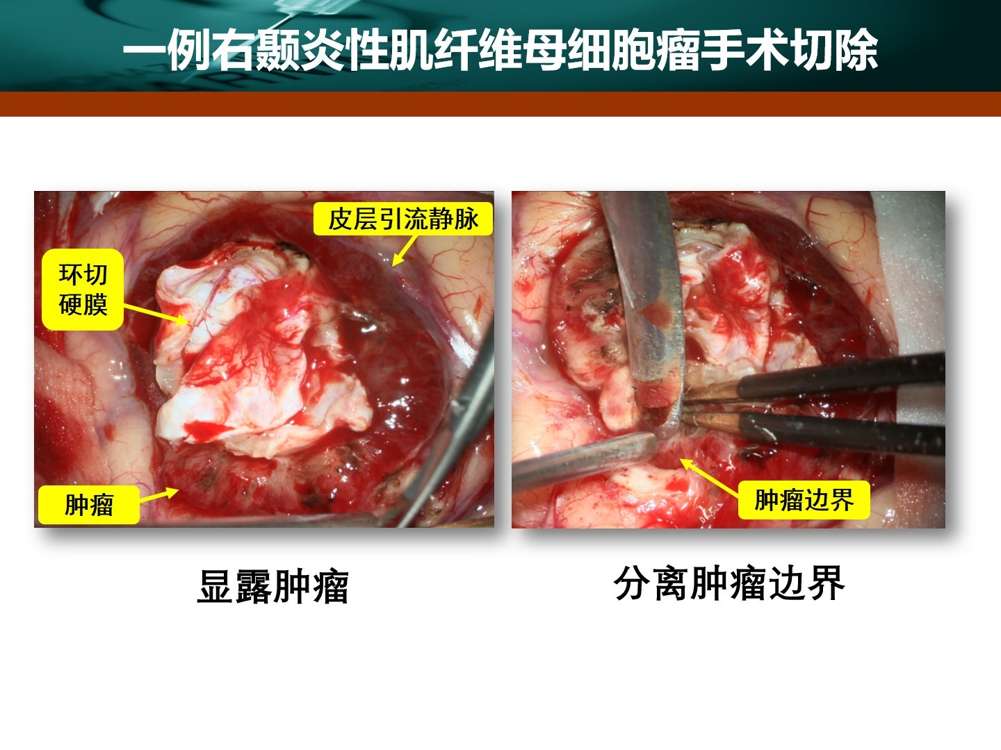 王拓教授團隊一例右顳炎性肌纖維母細胞瘤手術切除