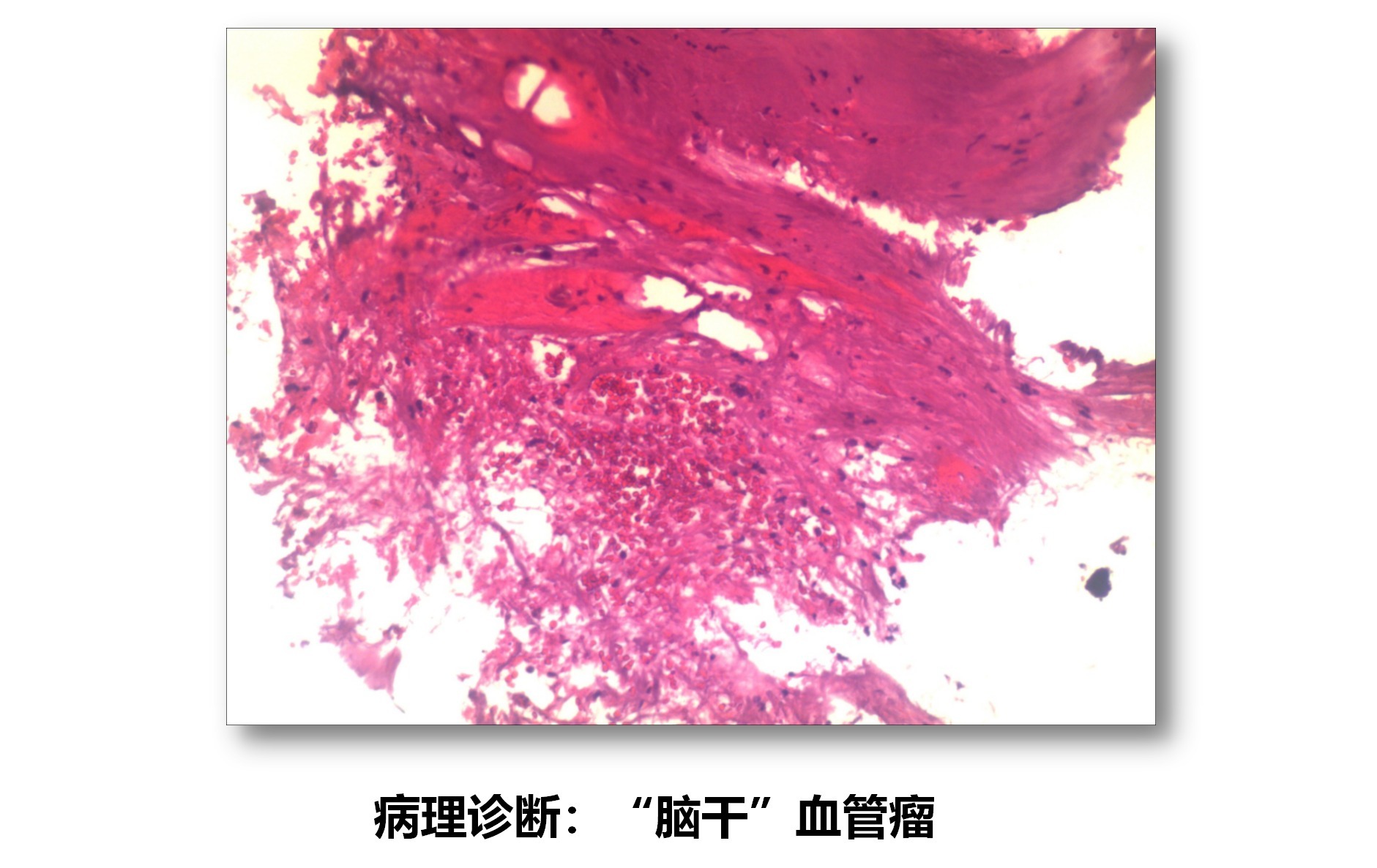 一例脑干海绵状血管瘤切除术_10.png
