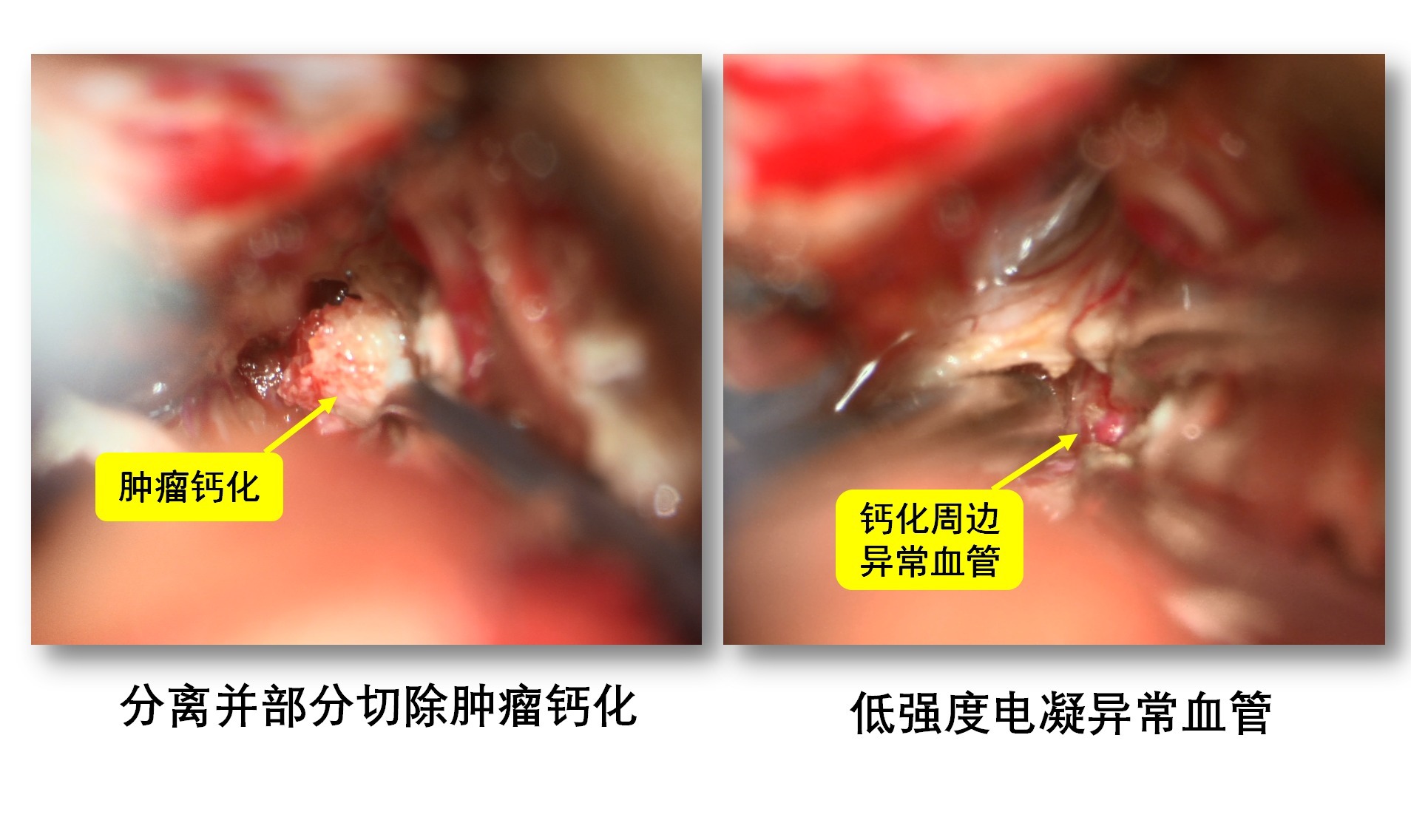 一例脑干海绵状血管瘤切除术_08.png