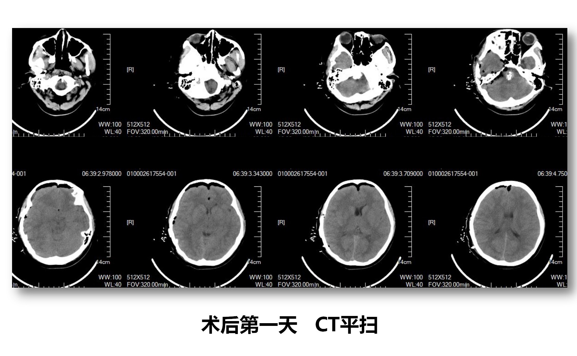 一例脑干海绵状血管瘤切除术_09.png