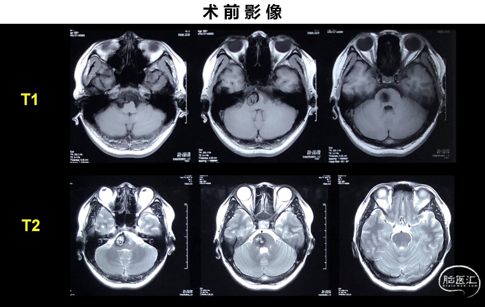 一例脑干海绵状血管瘤切除术_02.png