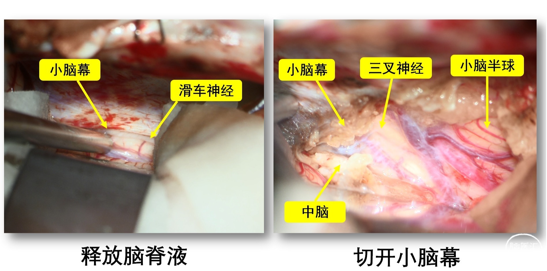 一例脑干海绵状血管瘤切除术_05.png