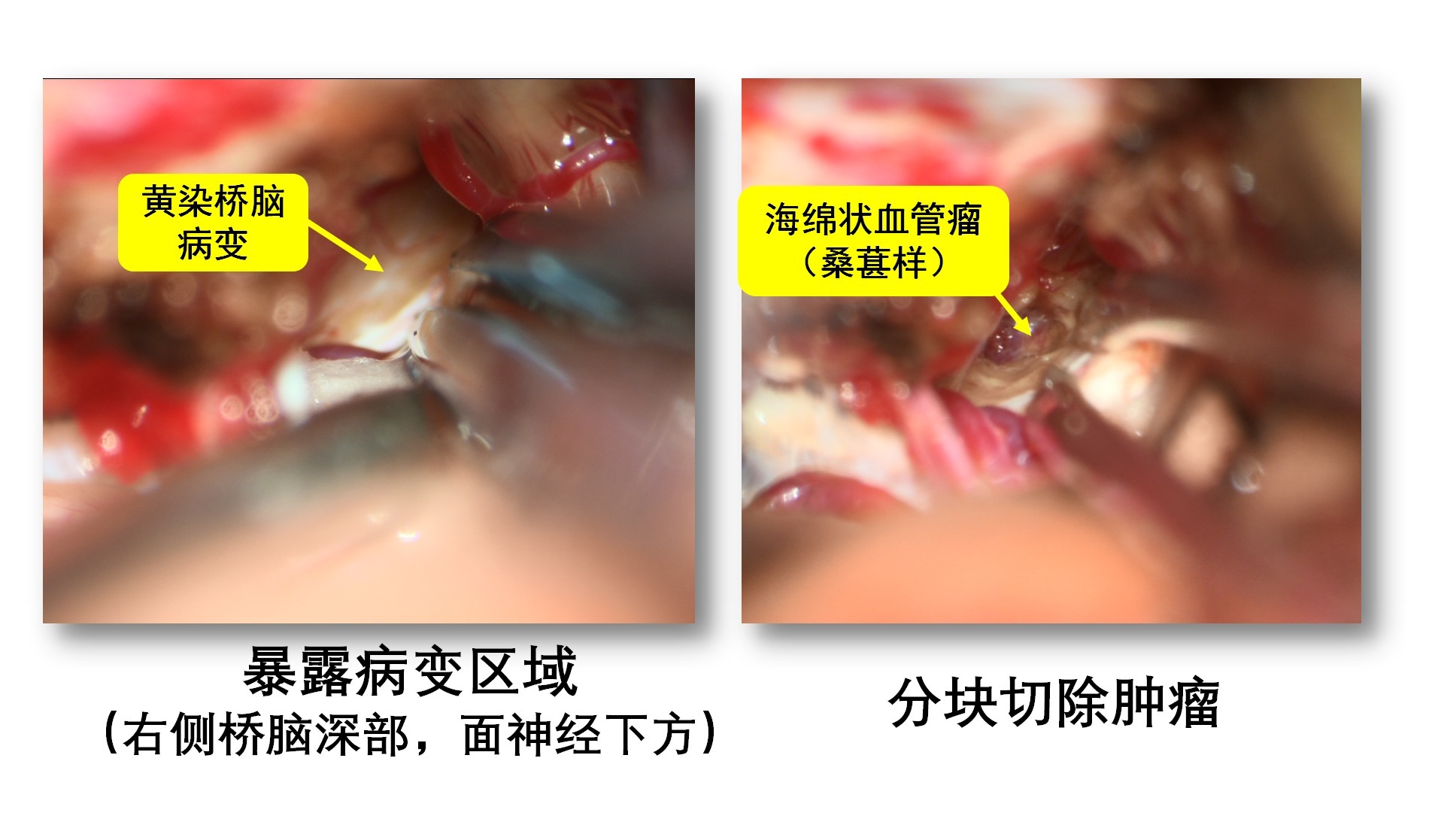 一例脑干海绵状血管瘤切除术_07.png