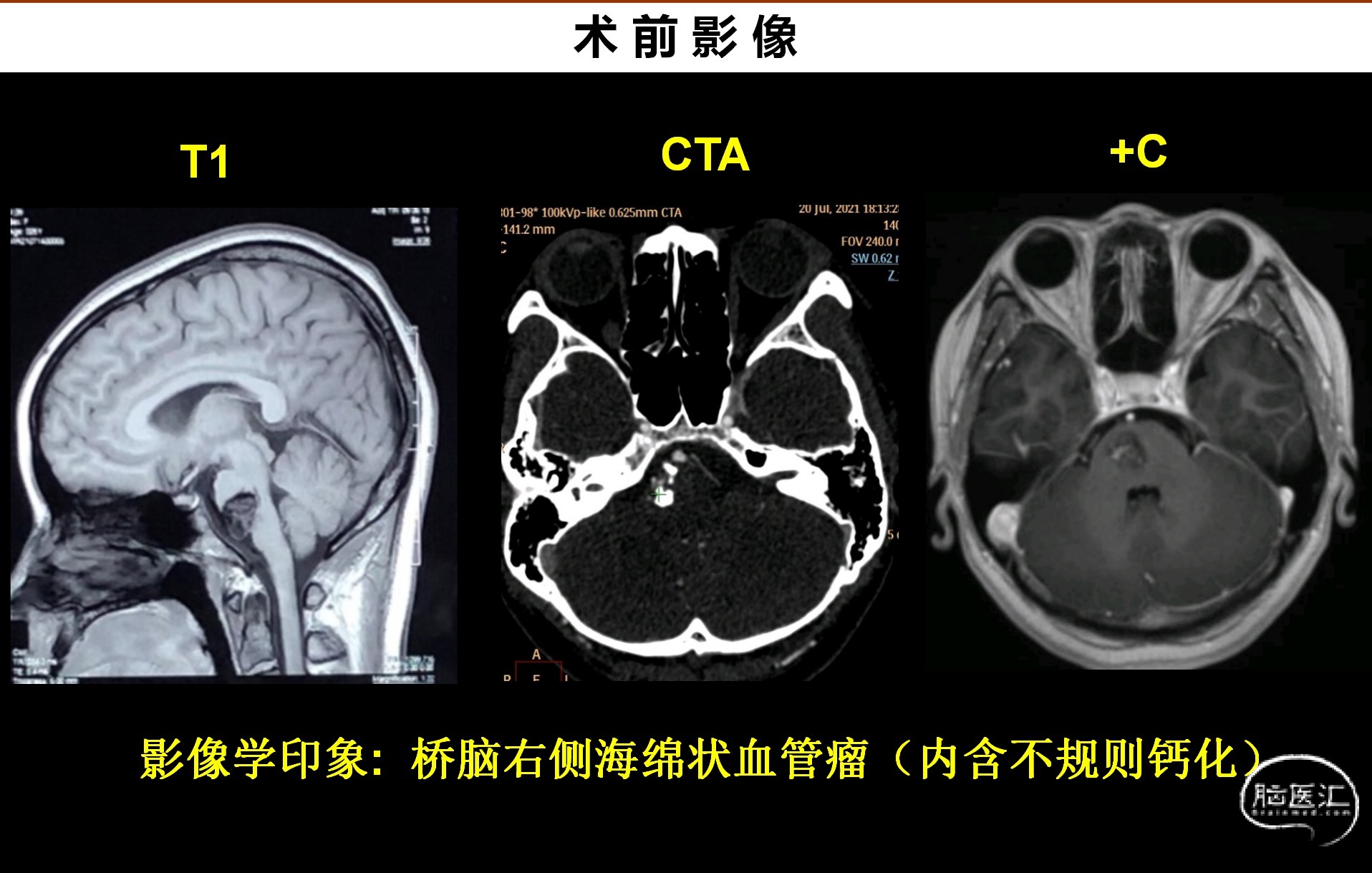一例脑干海绵状血管瘤切除术_03.png