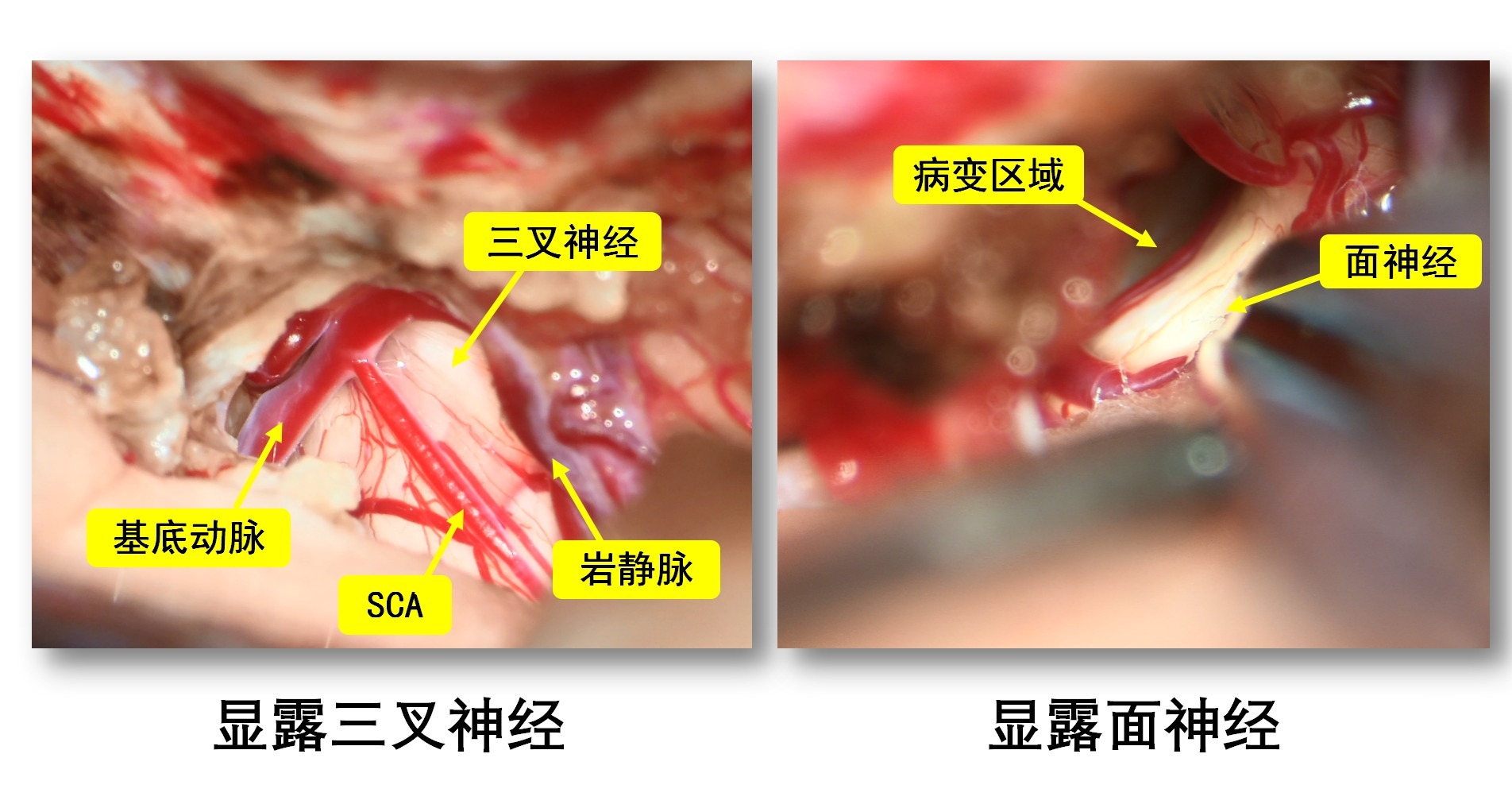 一例脑干海绵状血管瘤切除术_06.png