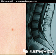 终丝增粗型脊髓栓系图片