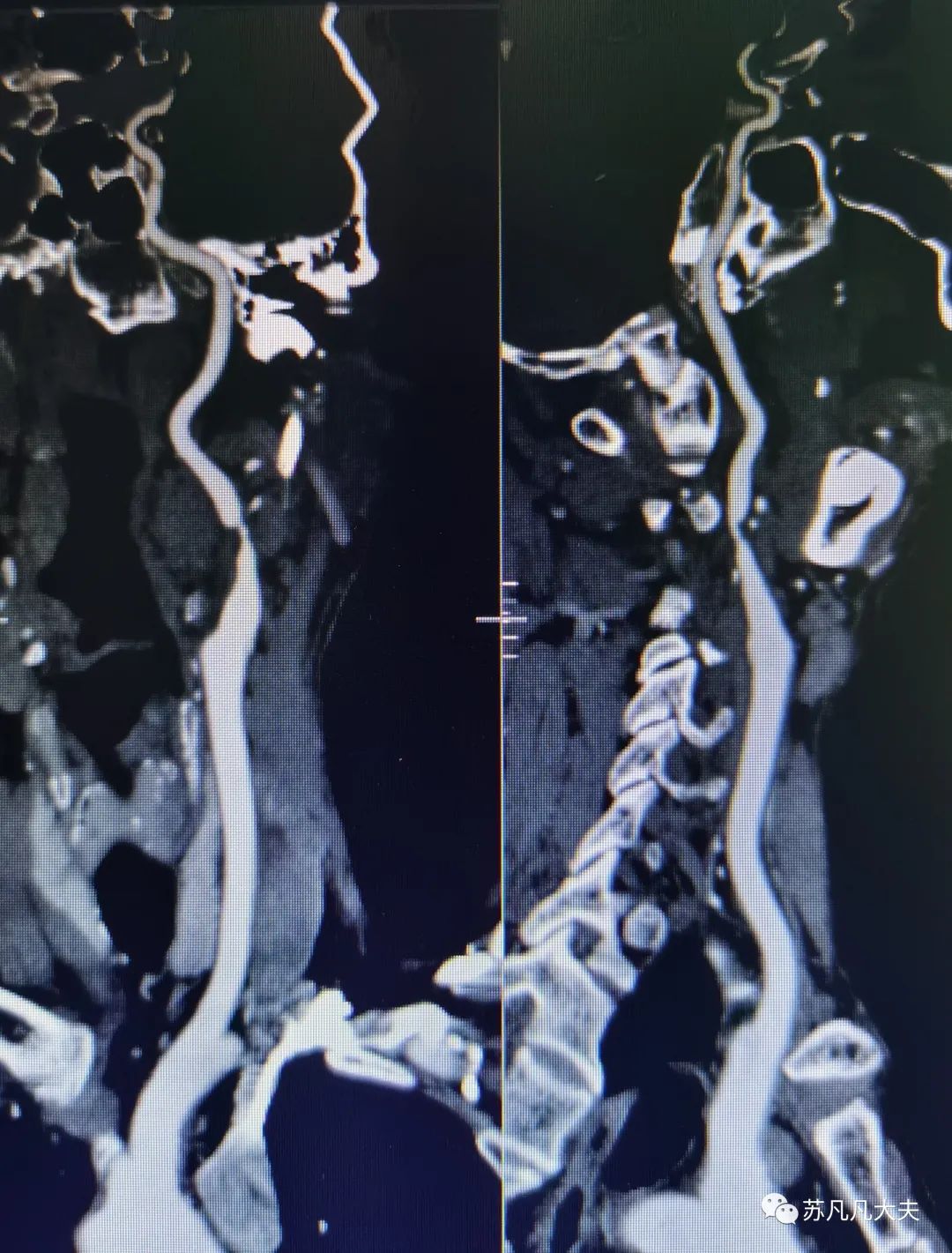 头颈部血管cta图片