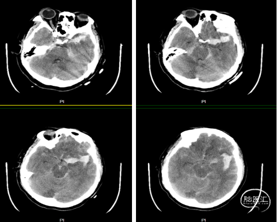 图1. 头颅ct示广泛蛛网膜下腔出血,左侧侧裂为主. 术前dsa(图2)结果