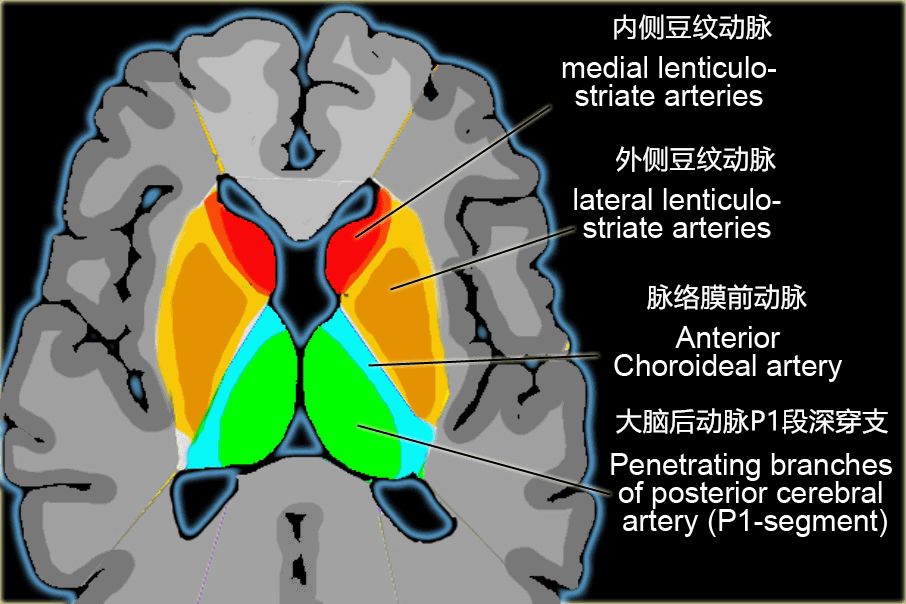 脑动脉瘤夹闭术后脑梗死脉络膜前动脉梗死