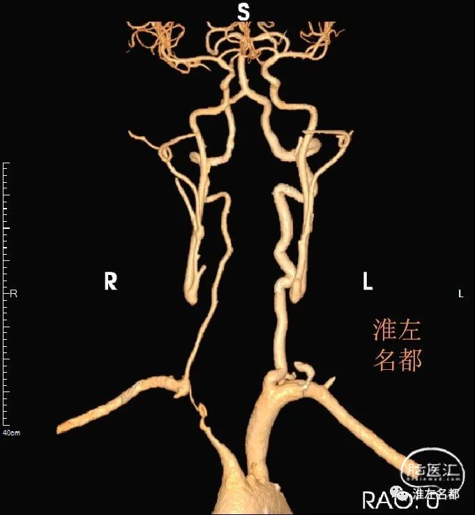影像读片稳定期的多发性大动脉炎弓上血管闭塞cta和管壁mri