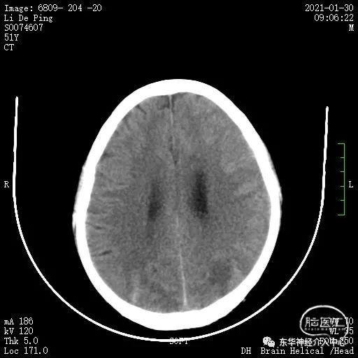 複查頭部ct 確實可以看到頂葉小灶性缺血灶,但是非功能區,不至於導致