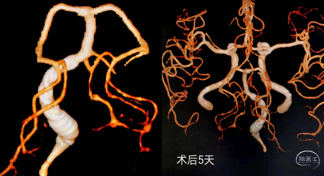 ocin趙開軍國產血流導向裝置tubridge治療顱內椎動脈夾層動脈瘤