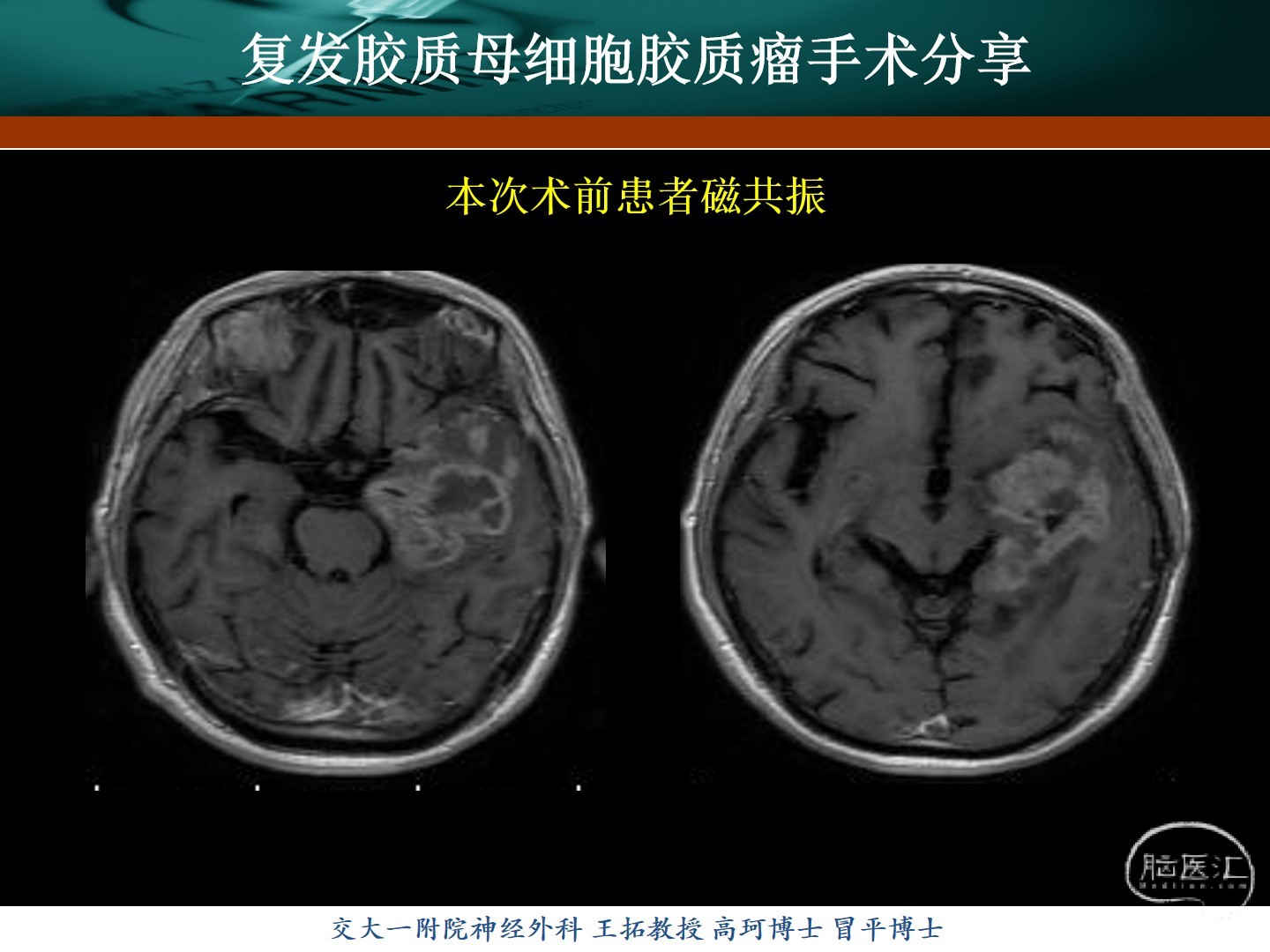 王拓教授團隊復發膠質母細胞瘤手術分享