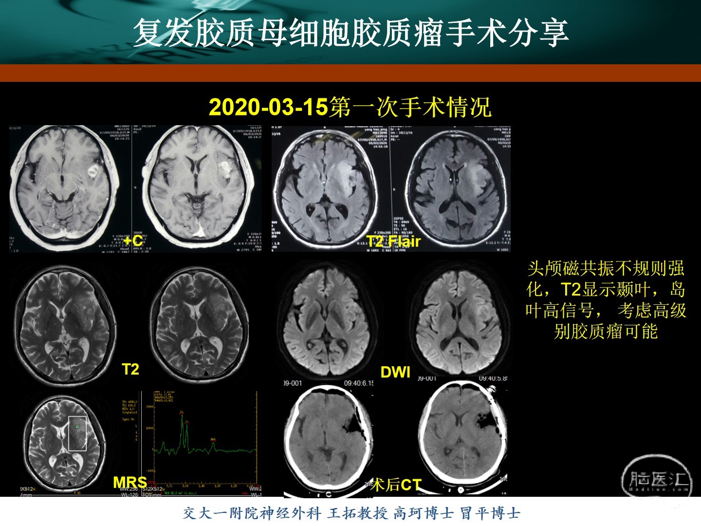 王拓教授團隊復發膠質母細胞瘤手術分享