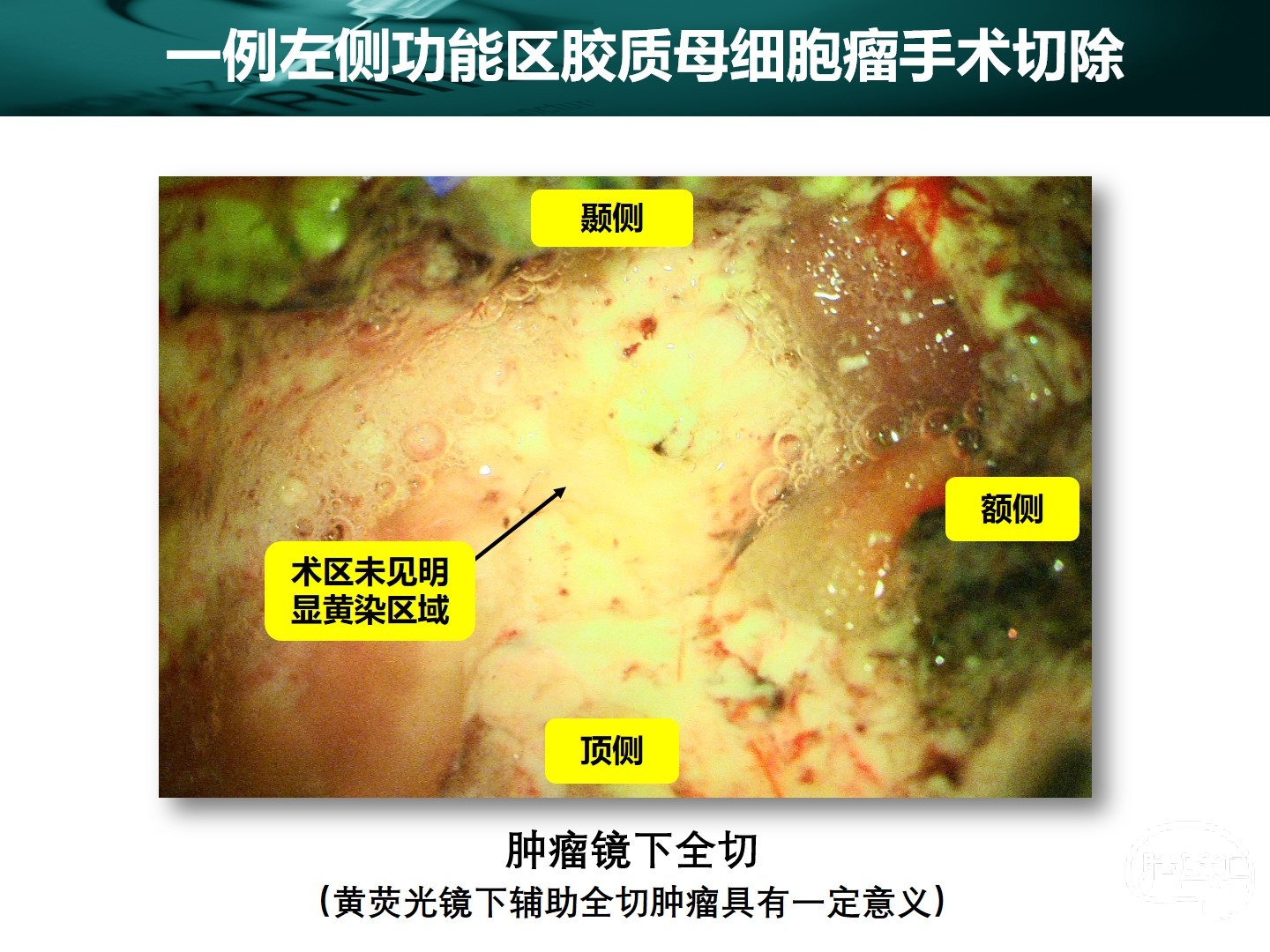 西安交通大學第一附屬醫院王拓教授團隊一例左側功能區膠質母細胞瘤