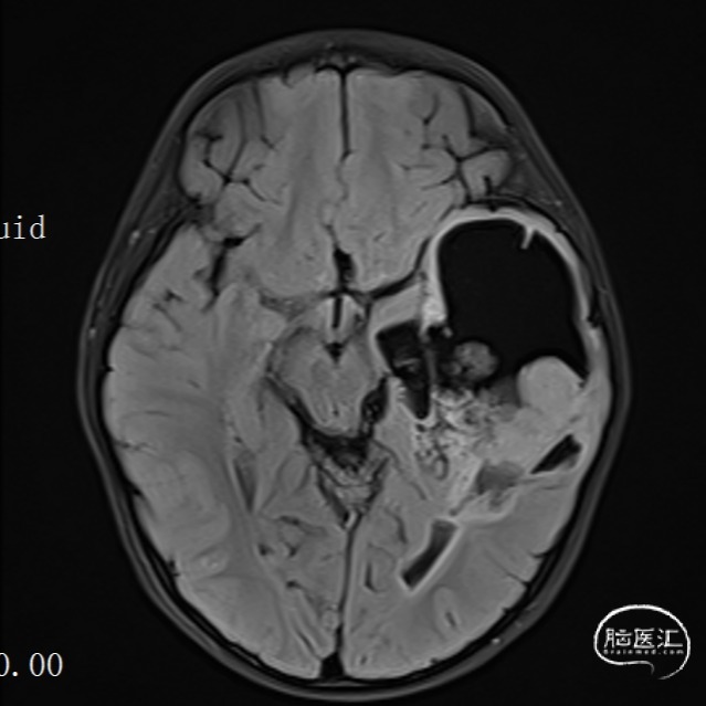 5cm,腫塊內側,大腦大靜脈池區及小腦半球可見多發增粗迂曲血管影,增強