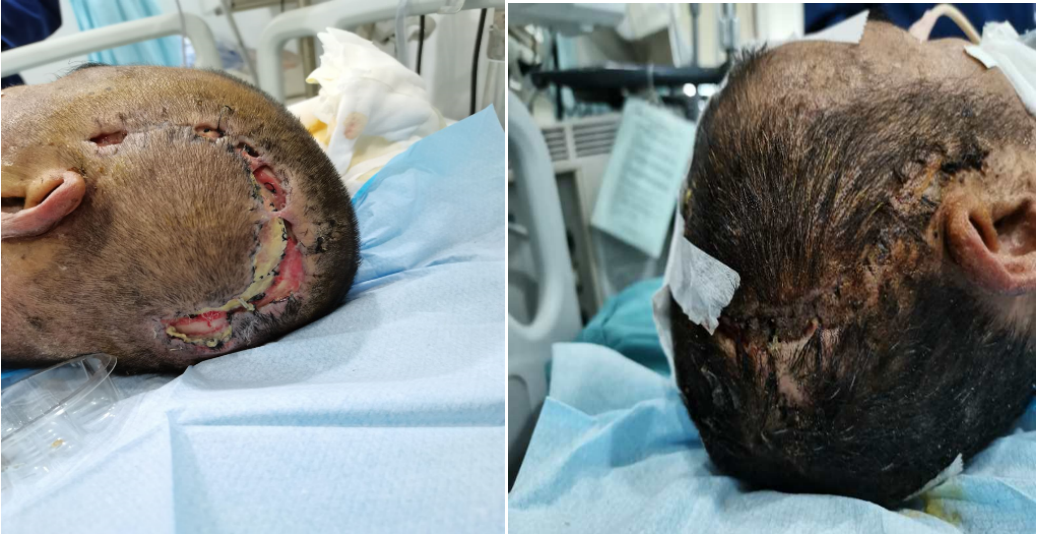 重型颅脑损伤术后手术部位切口感染一例神经急重症系列五浙二神外周刊