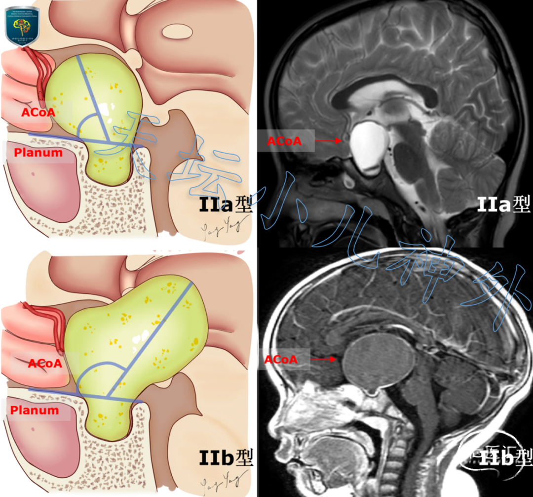 ii型:前交通動脈(acoa)位於瘤體蜂腰部,需要分別通過第i,第iv間隙切除