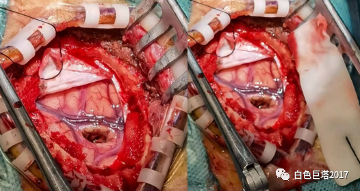 脑皮质切除术图片