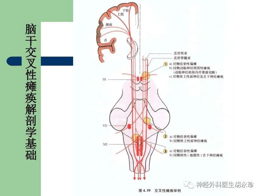 腦幹及其小腦的血供你瞭解多少梗死了呢