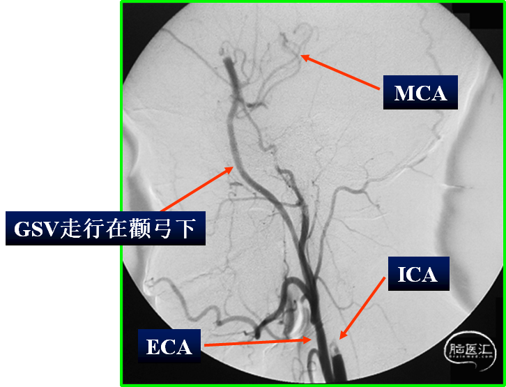 病例三左側頸內動脈海綿竇段動脈瘤:頸外動脈-大隱靜脈-大腦中動脈