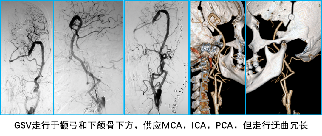 病例五破裂,解離,血栓,左側m1動脈瘤:頸外動脈-橈動脈-大腦中動脈搭橋